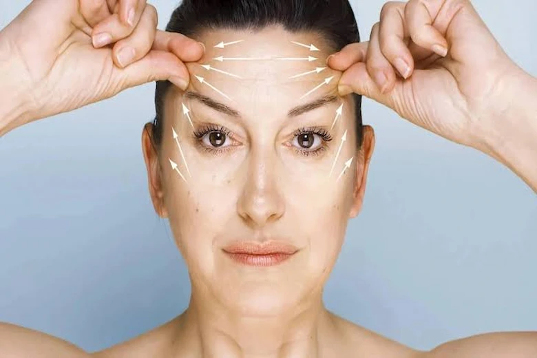 تصویری از لیفت شقیقه با نخ